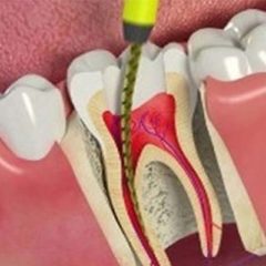 Root Canal Therapy Root Canal Therapy